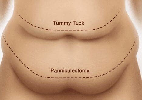 Traditional tummy tuck illustration - tummy tuck bellevue