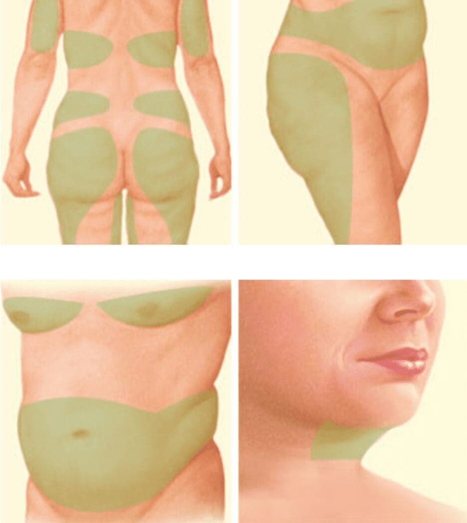 Areas treated by liposuction 2-13-2023 kd