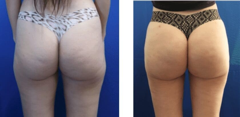 Brazilian butt lift before and after