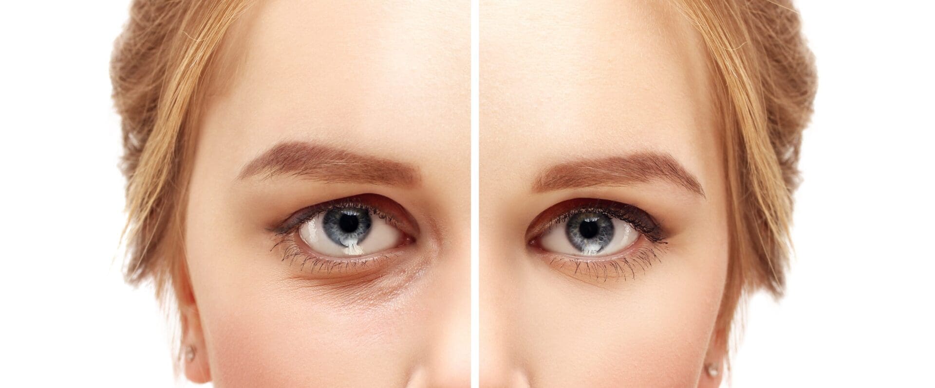 Lower-eyelid blepharoplasty. Asian eyelid surgery. Upper blepharoplasty. Correcting  the aging process